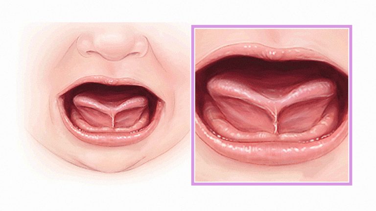 Bebeklerde Dil Bağı Nedir?